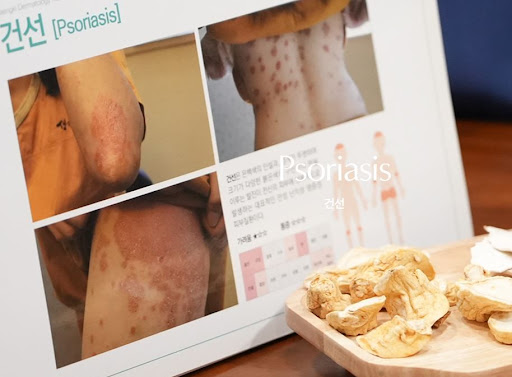 생기한의원 건선 정보에서 정리한 인설 발생 특징 살펴보기